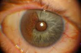 меланома глаза